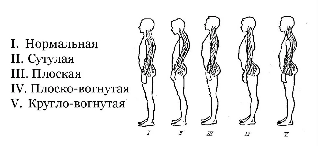 Лечение сколиоза за границей